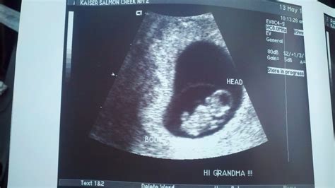 Parsons' Bebe: Ultrasound-8 Weeks