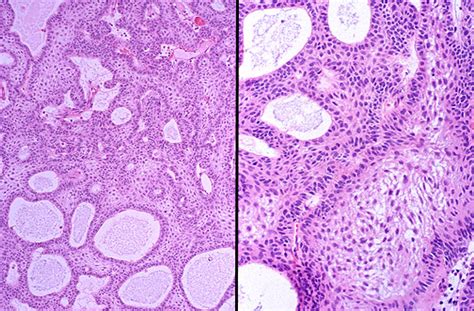 Craniopharyngioma Histology