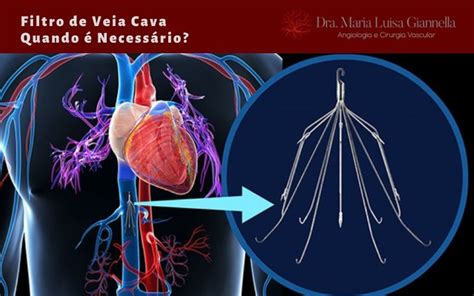 Filtro de Veia Cava - Quando é Necessário? | Dra Maria Luisa