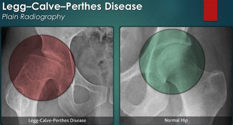 Legg-Calve-Perthes Disease - Causes, Symptoms, Treatment