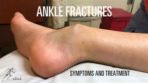 Ankle fracture: Types, signs and symptoms and treatment - YouTube