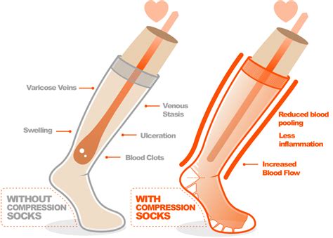 The Benefits of Compression Socks for a Sprained Ankle - Vitalsox