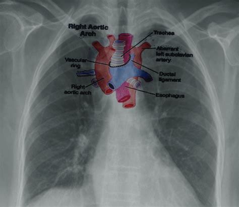 [Figure, Right aortic arch Image courtesy S Bhimji MD] - StatPearls ...