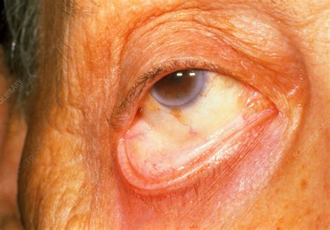 Pale eyelid due to myelodysplastic anemia - Stock Image - M108/0420 ...