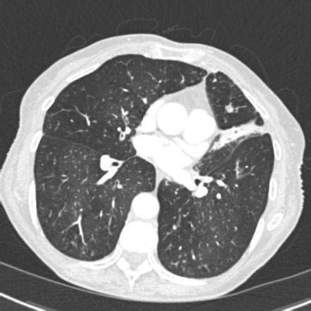 Tree-in-bud sign (lung) | Radiology Reference Article | Radiopaedia.org