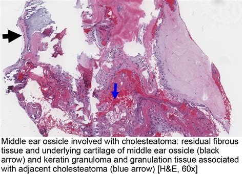 Cholesteatoma Histology