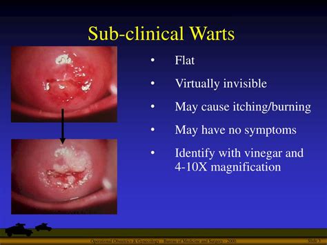 PPT - Human Papilloma Virus HPV PowerPoint Presentation, free download - ID:574515