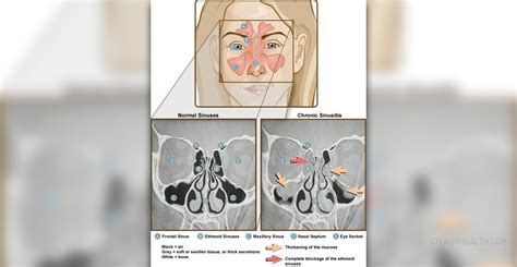 How to treat a fungal sinus infection | General center | SteadyHealth.com