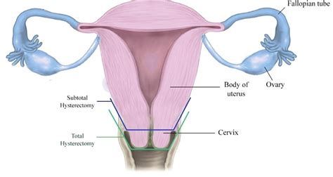 Hysterectomy Procedure Indications Complications, 55% OFF