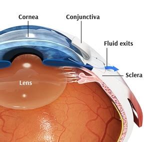 Glaucoma Surgery St. Leonards | Laser Treatment | Vision Loss North Shore