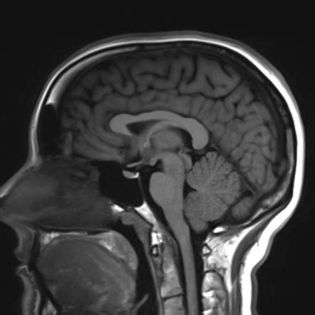 Normal brain MRI | Radiology Case | Radiopaedia.org