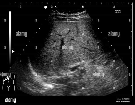 Healthy liver, ultrasound scan Stock Photo - Alamy