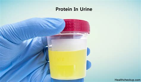 Protein in Urine Normal, Low, High Ranges | Signs,Types of Proteinuria