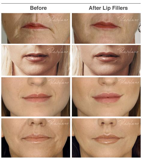 Lip enhancement with Dermal Fillers - Face Clinic London
