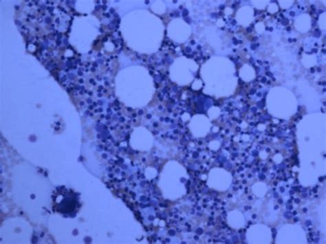 Hypocellular marrow with myeloid hypoplasia in FS. | Download Scientific Diagram