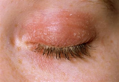 Eczema on Eyelid - Symptoms, Causes, Pictures, Treatment