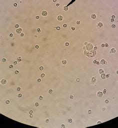 RBC(red) WBC(yellow) Epi cell(green) in urine sample ; 40x | Medical laboratory technician ...