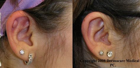 New York keloid removal and scar treatment and improvement