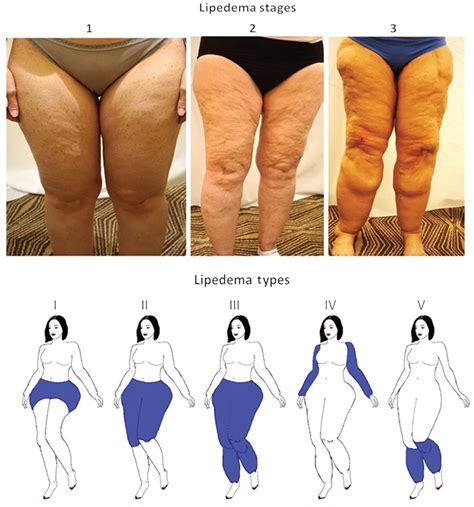 Learn About Stages And Types Of Lipedema