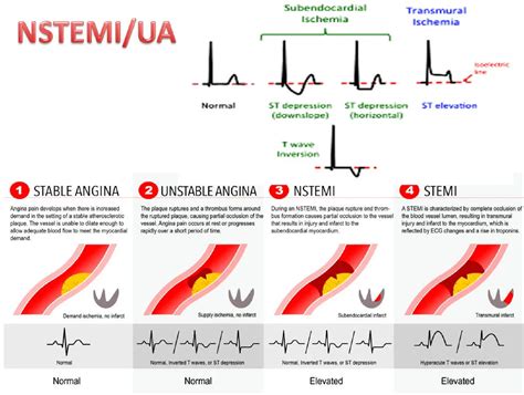 STEMI V NSTEMI Ausmed The Difference Between A STEMI And An, 42% OFF