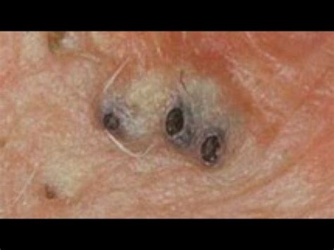 old blackheads extraction compilation - YouTube