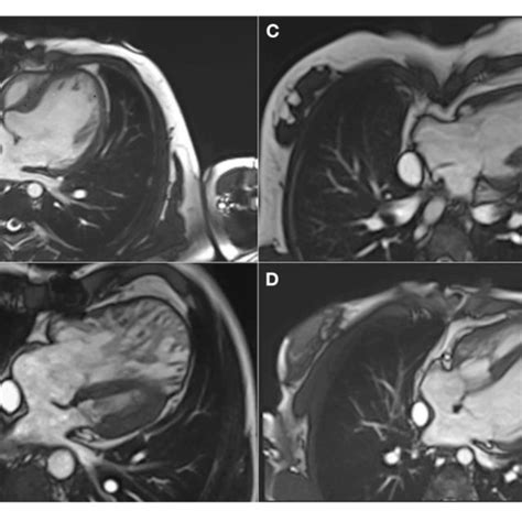 | Hepatocellular carcinoma in a 30-year-old man with Fontan palliation.... | Download Scientific ...