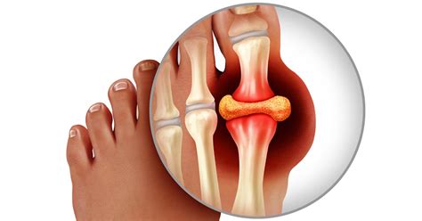 Gout / Gouty Arthritis | Symptoms, Diagnosis and Treatment | HSS