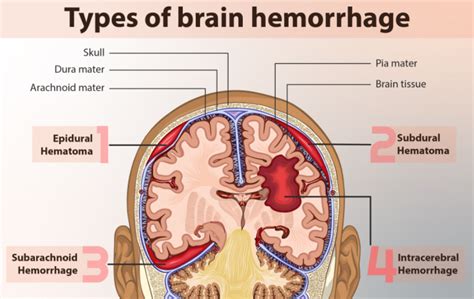 두개 내 출혈과 뇌출혈의 차이점 - 지식 - Trando 3D Medical Technology Co., Ltd