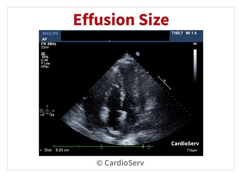 Cardiac Tamponade Echo