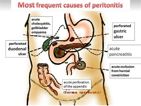 Ruptured Appendix Peritonitis