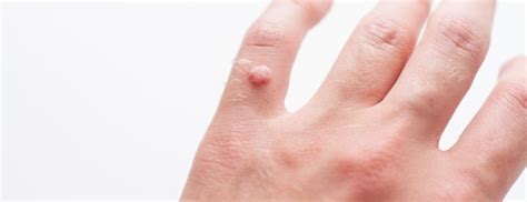 Warts On Hands & Fingers | Holland & Barrett