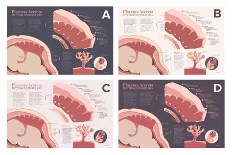 Placenta Accreta Spectrum Disorders on Behance