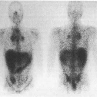 (PDF) Gallium-67 as a Tumor-seeking Agent in Lymphomas - a Review