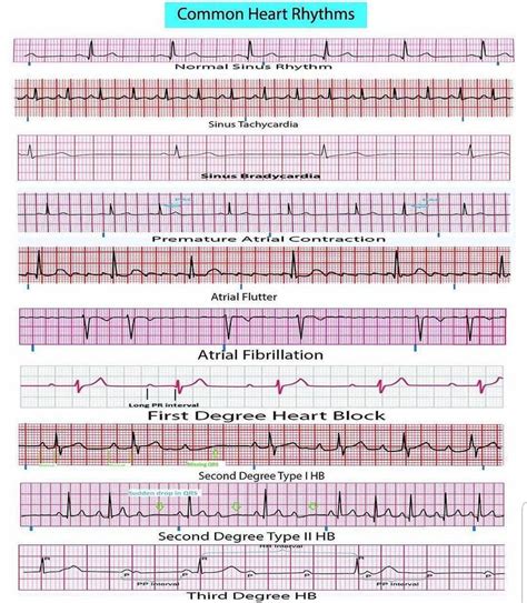 Common heart Rhythms | Ekg interpretation, Ekg interpretation cheat ...