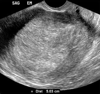 [36+] Uterine Cancer Ultrasound Endometrial Hyperplasia