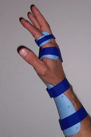 Extensor Tendon Injuries - Dr. Groh