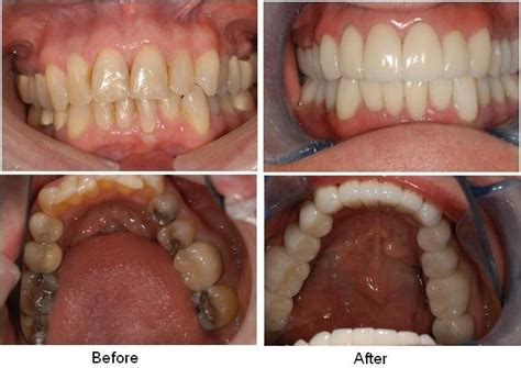 Porcelain Crowns & Bridges - Griffith Dental Surgery