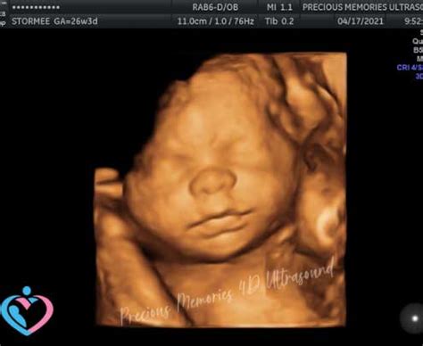 3D Pregnancy Ultrasounds Atascocita TX | 3D Pregnancy Ultrasounds Humble TX