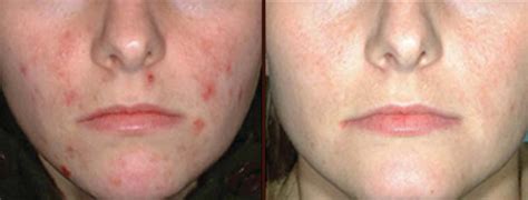 IPL Rosacea and Acne Treatment - Cosmetic Surgery in Virginia Beach, VA ...