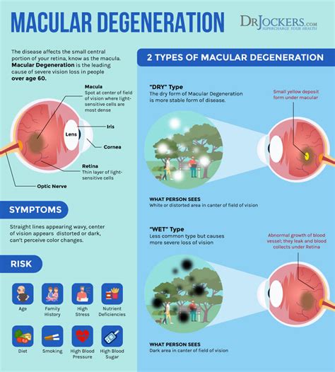 Macular Degeneration: Causes, Symptoms & Natural Strategies