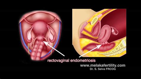 Laparoscopic surgery for endometriosis - YouTube