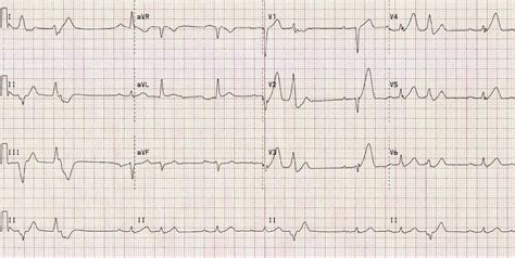 Anterior Myocardial Infarction • LITFL • ECG Library Diagnosis