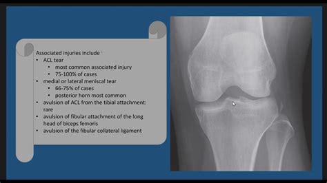 Segond fracture case discussion - YouTube