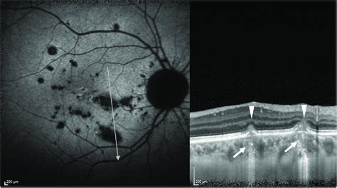 A patient with punctate inner choroidopathy (PIC). The autofluorescence... | Download Scientific ...