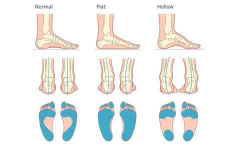 Fitting Ergonomic Insoles to Foot Shapes | INSITE Insoles