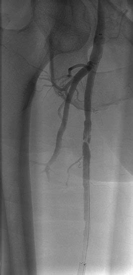 59: Stenosis in a Superficial Femoral Artery | Clinical Gate