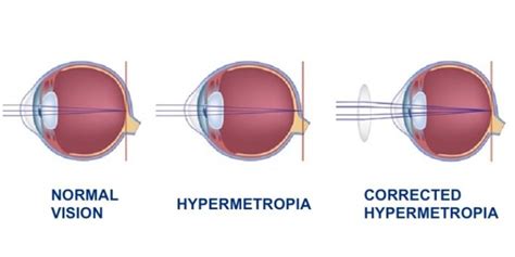 Hypermetropia - Causes and Treatments | Dr. Alberto Bellone