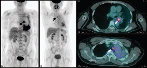 PET/CT scans showed the mass with increased 18-FDG uptake in left main... | Download Scientific ...