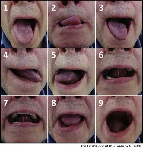 Long-term functional outcomes and quality of life after partial glossectomy for T2 squamous cell ...