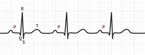 The P Wave | ECG Basics - MedSchool